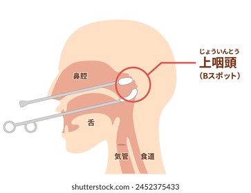 How to perform and illustrate Epipharyngeal Abrasive Therapy;B-spot therap[TRANSLATE];Epipharyngeal Abrasive Therapy,B-spot