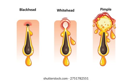 How a Pimple, Whitehead and Blackhead forms Process