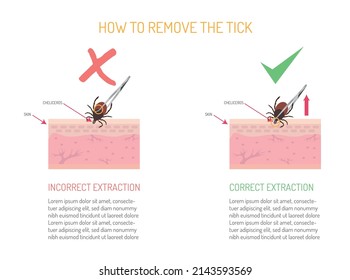 How to properly remove a tick