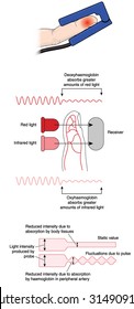 How a pulse oximeter works, showing absorption levels of red and infrared light by oxygenated and deoxygenated blood pulsing through the finger tip