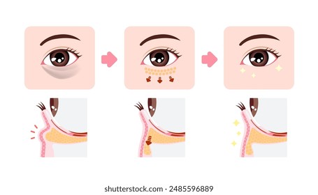 How to remove dark circles under the eyes with Lower blepharoplasty (Transconjunctival blepharoplasty)