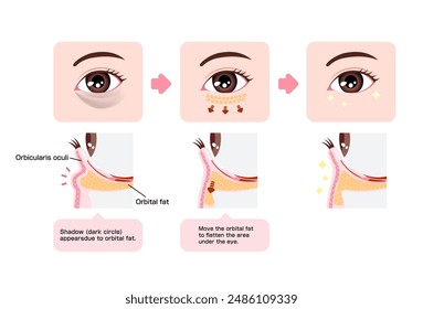 How to remove dark circles under the eyes with Lower blepharoplasty (Transconjunctival blepharoplasty). Translation: Orbicularis oculi, Orbital fat, Shadow (dark circle) 
appears due to orbital fat.