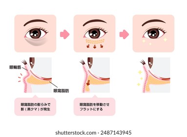 How to remove dark circles under the eyes with Lower blepharoplasty (Transconjunctival blepharoplasty). . Translation: Orbicularis oculi, Orbital fat, Shadow (dark circle) 
appears due to orbital fat.