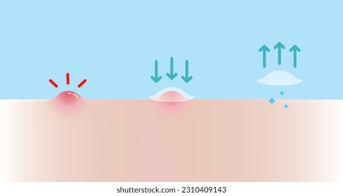 How to use acne pimple patch for inflammatory acne vector illustration on blue background. Step of use, direction for use acne patch absorbing papule on skin face. Skin care and beauty concept.