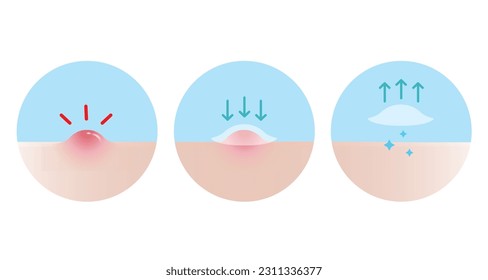 How to use acne pimple patch for inflammatory acne vector icon set illustration on white background. Step of use, direction for use acne patch absorbing papule on skin face. Skin care concept.