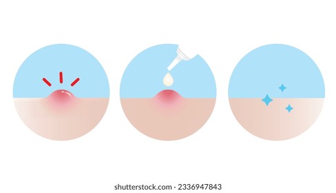 Cómo usar el tratamiento de la pimple acné para el icono del vector del acné inflamatorio, muestra el fondo blanco. Paso de uso, dirección de uso crema de acné, gel y loción absorbiendo la púpula en la cara de la piel.