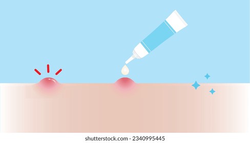 How to use acne pimple treatment for papule vector illustration on sky blue background. Step of use, direction for use acne cream, gel and lotion absorbing inflammatory acne on skin face.