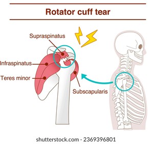 How and why rotator cuff tears occur from the lateral view - Shutterstock ID 2369396801
