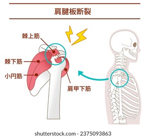 How and why rotator cuff tears occur from the lateral view ;Translate supraspinatus muscle
,Infraspinatus muscle,Teres minor muscle,Subscapularis muscle