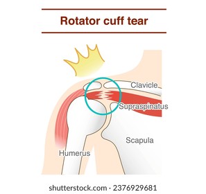 How and why shoulder rotator cuff tears occur