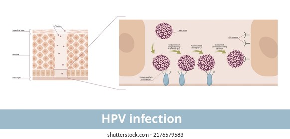 HPV infection. Process of human papillomavirus infection caused by a DNA virus from the Papillomaviridae family with its exposing and cell receptor binding stages.