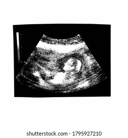 Huge ultrasound picture in mother's womb. Vector illustration in black and white ultrasound Image. Medical and Health of the fetus . Realistic embryo sonogram Realistic , for cards, posters, postcard 