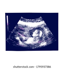 Huge ultrasound picture in mother's womb. Vector illustration in black and white ultrasound Image. Medical and Health of the fetus . Realistic embryo sonogram Realistic , for cards, posters, postcard 