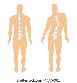 human anatomical silhouette with the spine. healthy spine illustration and spine with scoliosis. Modern Medical vector infographics. Medic anatomy