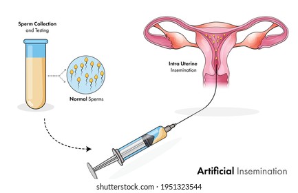 Human Anatomy: Artificial Insemination For Women Pregnancy.  