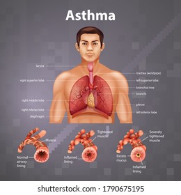 Human Anatomy Asthma Diagram Illustration