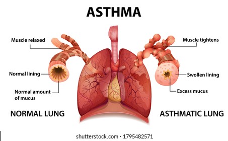 Human Anatomy Asthma Diagram Illustration