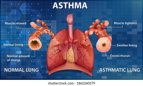 Human Anatomy Asthma Diagram Illustration