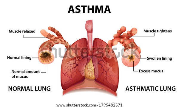 Human anatomy Asthma
diagram illustration