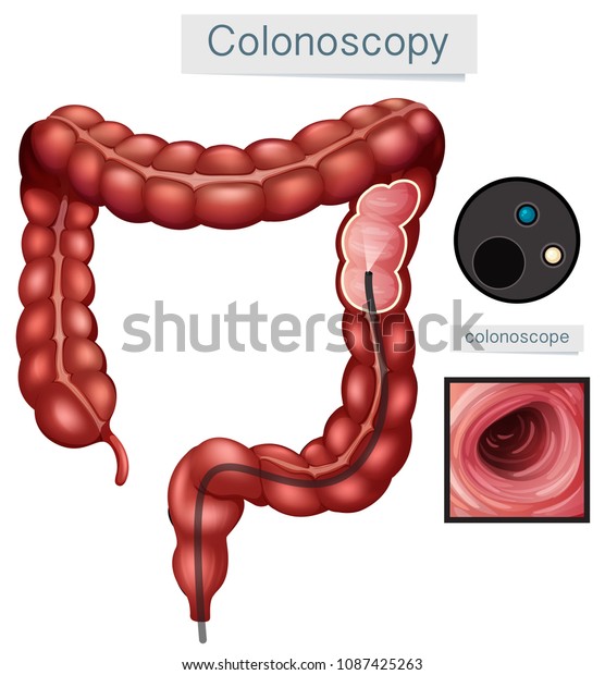 Human Anatomy Colonoscopy on White
Background illustration