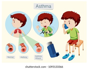 A Human Anatomy And Health Asthma Illustration