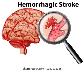 Hemorrhagic Stroke Images, Stock Photos & Vectors | Shutterstock