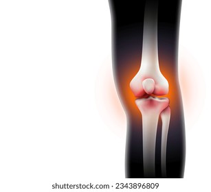 Anatomía humana de la inflamación de las articulaciones de la rodilla que frotaba los huesos con hinchazón y rojo. archivo EPS de ilustración.
