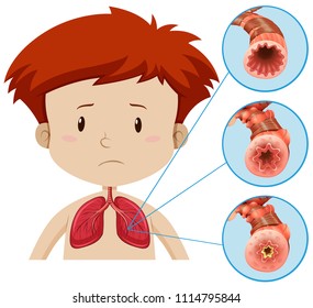 A Human Anatomy of Lung Problem illustration