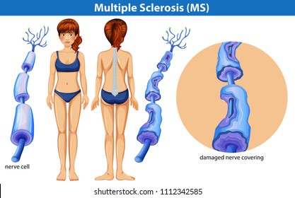 A Human Anatomy of Multiple Sclerosis illustration