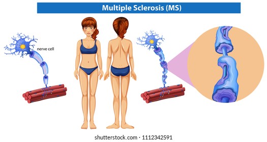 A Human Anatomy of Multiple Sclerosis illustration