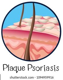 A Human Anatomy Plaque Psoriasis Illustration