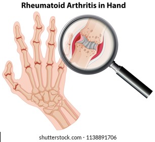 a nyak rheumatoid arthritise hogyan lehet azonosítani a csípőízület artrózisát