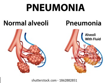 Human anatomy showing pneumonia illustration