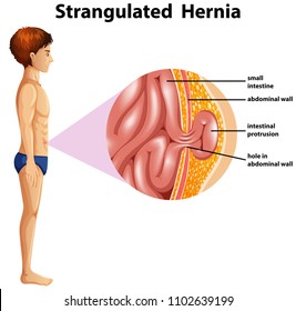 A Human Anatomy Strangulated Hernia illustration