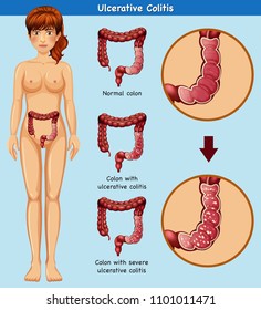 Human Anatomy of Ulcerative Colitis illustration
