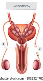 Human Anatomy of  Vasectomy on White Background illustration