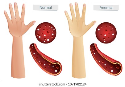 Anemia Images, Stock Photos & Vectors | Shutterstock