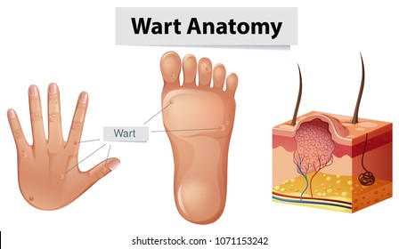 Human Anatomy Wart on Hand and Foot illustration