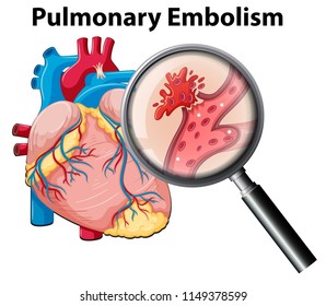 Human Anutomy Pulmonary Embolism Illustration Stock Vector (Royalty ...