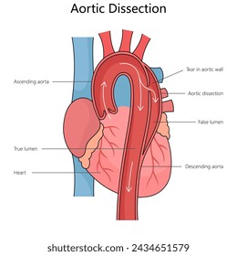 Human aortic dissection, showing the true and false lumens and a tear in the aortic wall structure diagram hand drawn schematic vector illustration. Medical science educational illustration