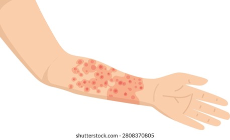 Human arm showing red hives and skin rash symptoms