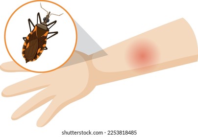 Human arm swollen from kissing bug bite illustration