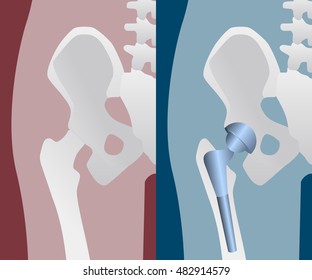 2,083 Artificial Hip Images, Stock Photos & Vectors 