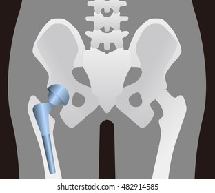 Human Artificial Hip Joint, Vector Illustration