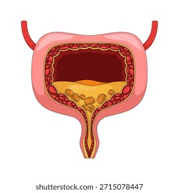 Seção transversal da bexiga humana com ilustrações de vetor 2D de cálculos urinários. Bloqueio de órgão interno. Acúmulo de minerais. Problema urológico objeto plano isolado no fundo branco. Imagem colorida em desenho animado