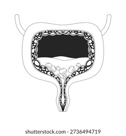 Human bladder cross-section with urinary stones outline illustration. Internal organ blockage. Mineral buildup. Urological issue 2D line object isolated on white. Monochrome vector ink linear image