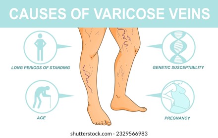 Cuerpo humano con problemas de salud. Causas de las venas varicosas. Infografía médica. Ilustración vectorial. Ilustración sanitaria. 