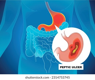 A human body with health problems. Inflammation on the stomach. Stomach (peptic) ulcer. Healthcare illustration. Medical illustration. Vector illustration. 