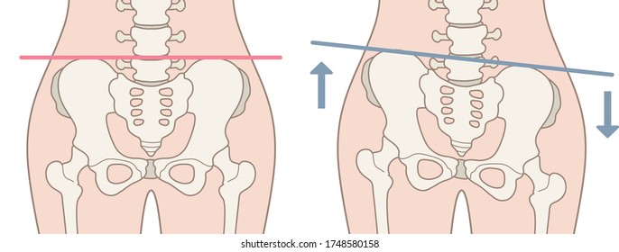 Human body (normal and distorted pelvis)