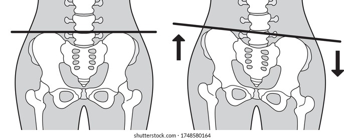 Human body (normal and distorted pelvis)